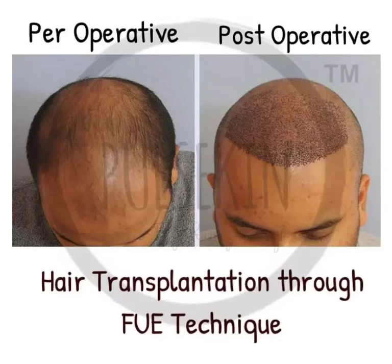 hair-transplant-by-FUE-technique